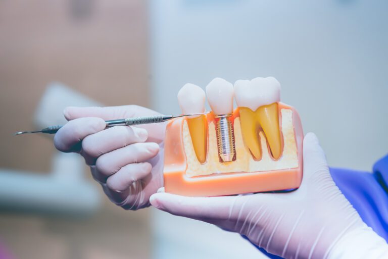 Dental Implants Broxburn